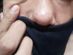 Tips Hilangkan Jerawat Akibat Pakai Masker, Simak Ini