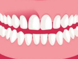 Ada Terapi Baru Untuk Bedah Gusi Turun