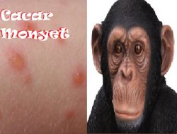 Waspadai Ancaman Cacar Monyet, Siloam Hospitals Yogyakarta Beri Edukasi Gejala dan Pencegahannya
