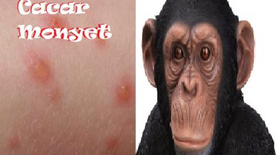 Virus Cacar Monyet