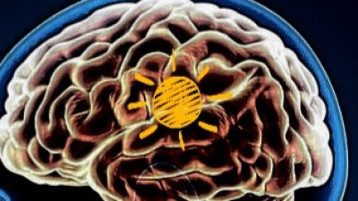 Apa itu Overthinking dan Cara Megatasinya